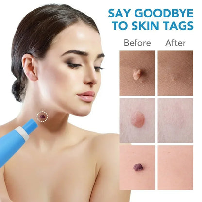 2-in-1 Automatic Skin Tag Removal Pen Kit